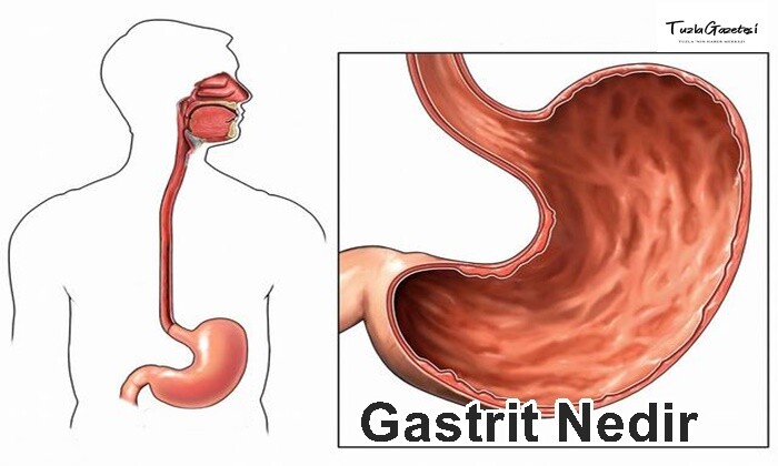 Gastrit Nedir neden olur