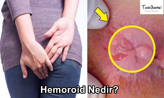 Hemoroid tedavisi Nedir?