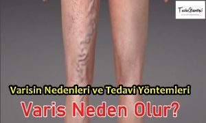 Varisin Nedenleri ve Tedavi Yöntemleri