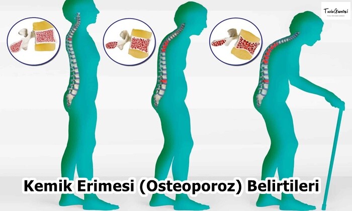 Kemik Erimesi (Osteoporoz) Belirtileri