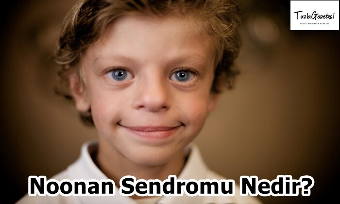 Noonan Sendromu Nedir