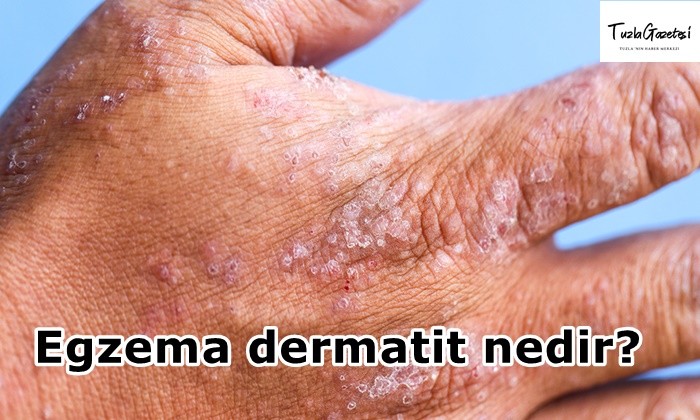 Egzema dermatit nedir