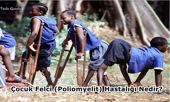 Çocuk Felci (Poliomyelit) Hastalığı Nedir