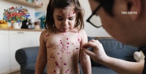 İstanbul'da Kızamık vakalarında artış kartal