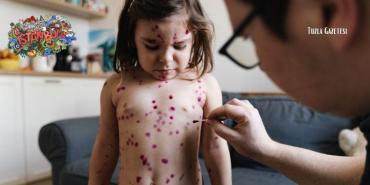 İstanbul'da Kızamık vakalarında artış kartal