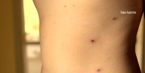 Kızamık Belirtileri Tedavisi ve Korunma Yöntemleri