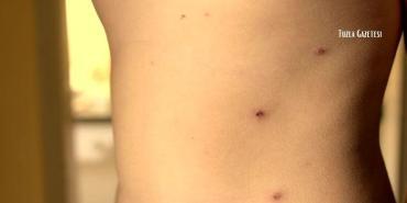 Kızamık Belirtileri Tedavisi ve Korunma Yöntemleri