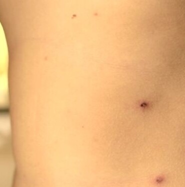 Kızamık Belirtileri Tedavisi ve Korunma Yöntemleri