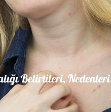 Uyuz Hastalığı Belirtileri, Nedenleri ve Tedavisi