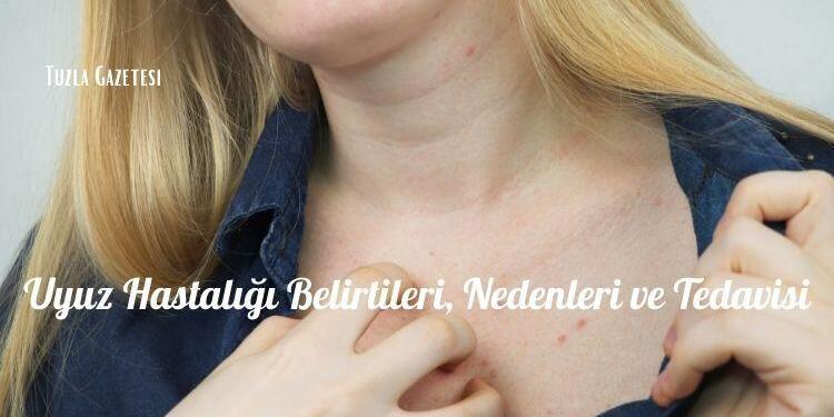 Uyuz Hastalığı Belirtileri, Nedenleri ve Tedavisi