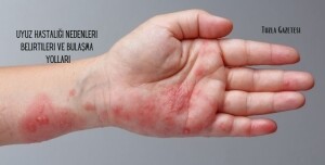 Uyuz Hastalığı Nedenleri Belirtileri ve Bulaşma Yolları, Uyuz Hastalığı Nedir