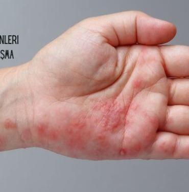 Uyuz Hastalığı Nedenleri Belirtileri ve Bulaşma Yolları, Uyuz Hastalığı Nedir