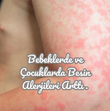 Bebeklerde ve Çocuklarda Besin Alerjileri Arttı