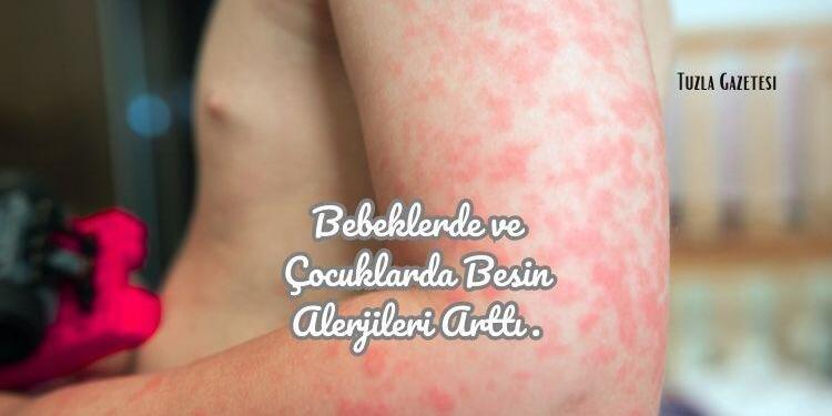 Bebeklerde ve Çocuklarda Besin Alerjileri Arttı