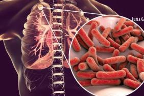 Verem Hastalığı Tanı Belirtiler ve Tedavi Yöntemleri