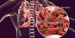 Verem Hastalığı Tanı Belirtiler ve Tedavi Yöntemleri