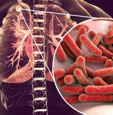 Verem Hastalığı Tanı Belirtiler ve Tedavi Yöntemleri