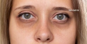 Göz Kayması Ameliyatı Nasıl Gerçekleştirilir?