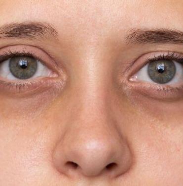 Göz Kayması Ameliyatı Nasıl Gerçekleştirilir?