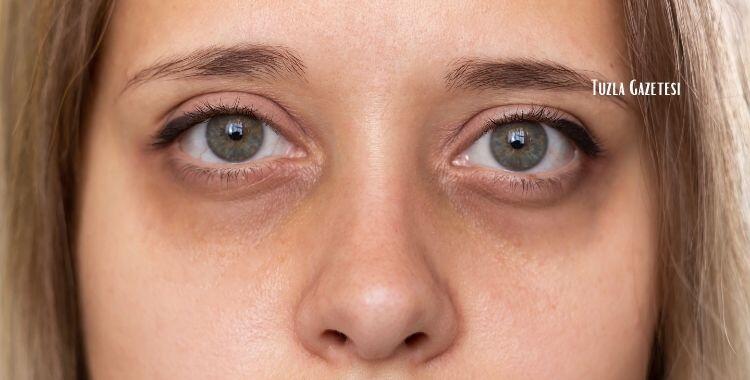 Göz Kayması Ameliyatı Nasıl Gerçekleştirilir?