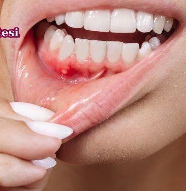Diş Eti Çekilmesi Belirtileri, Diş Eti Çekilmesi nedir